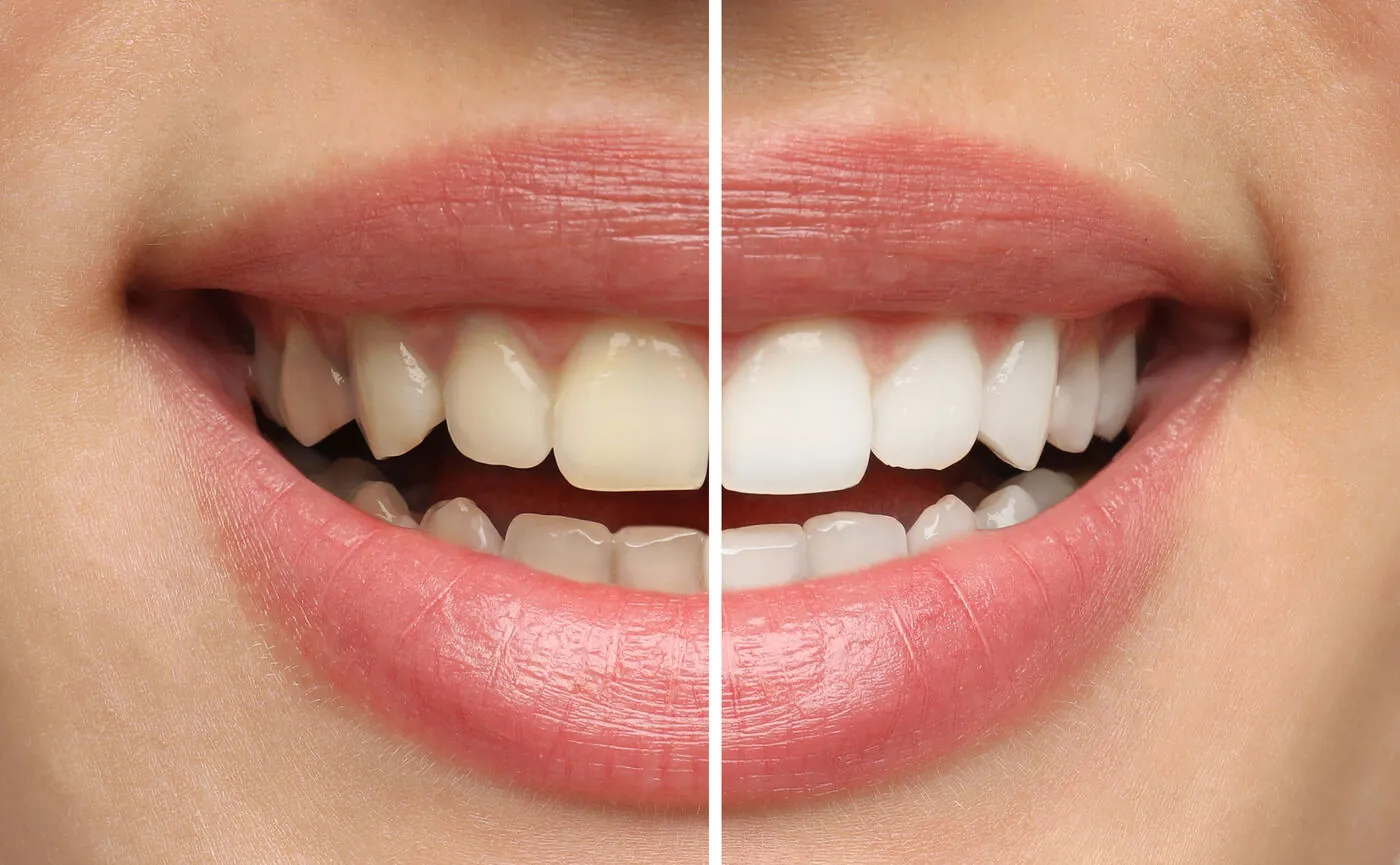 Before and after teeth whitening comparison