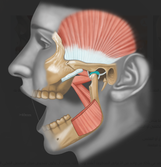 اضطرابات مفاصل الفك والوجه