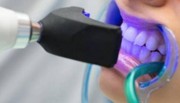 تبييض الأسنان بأحدث الطرق بمختلف الأجهزة (زووم – ليزر)